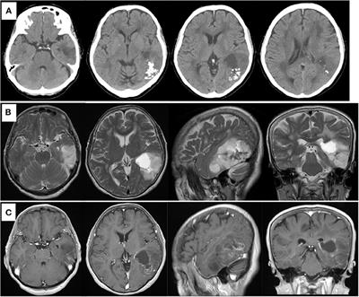 The Efficacy of Intraoperative Passive Language Mapping for Glioma Surgery: A Case Report